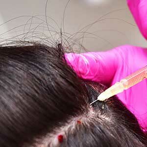 Behandlung Haarausfall Mesotherapie